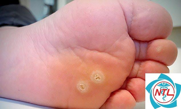 mụn cóc do HPV - Image 3