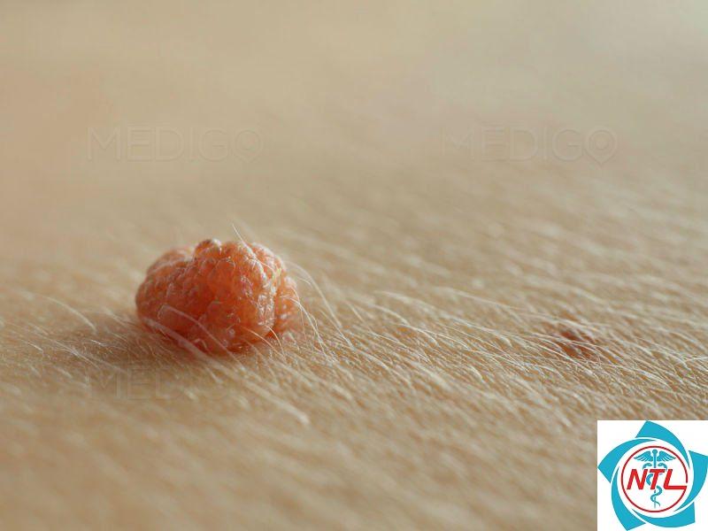 mụn cóc do HPV - Image 4