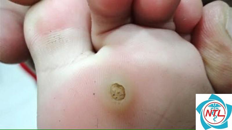 mụn cóc do HPV - Image 5