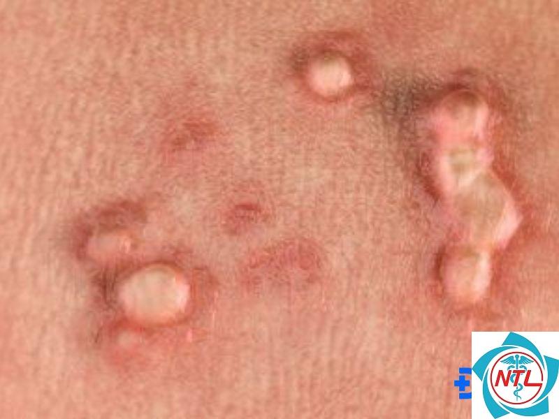 mụn cóc do HPV