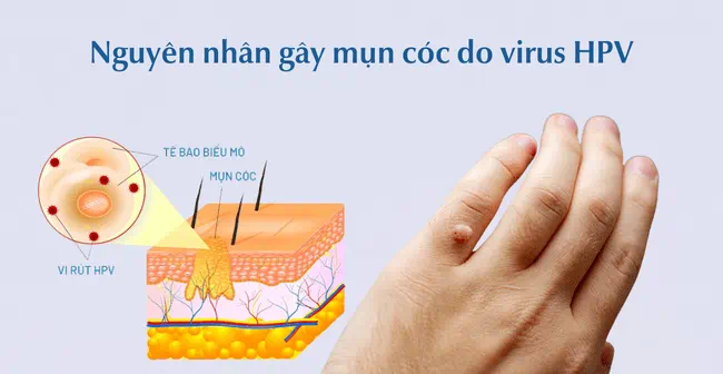 mụn cóc nhiều vị trí - Image 1