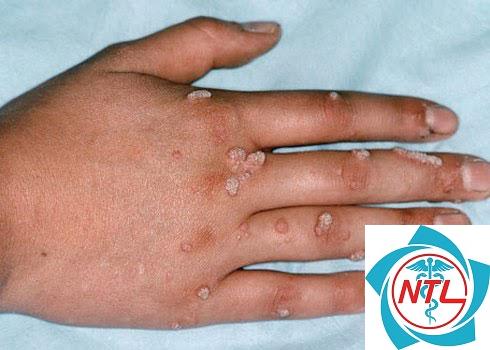 mụn cóc nhiều vị trí - Image 2