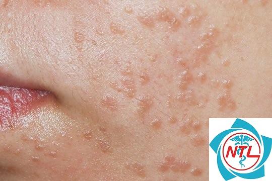 mụn cóc nhiều vị trí - Image 3