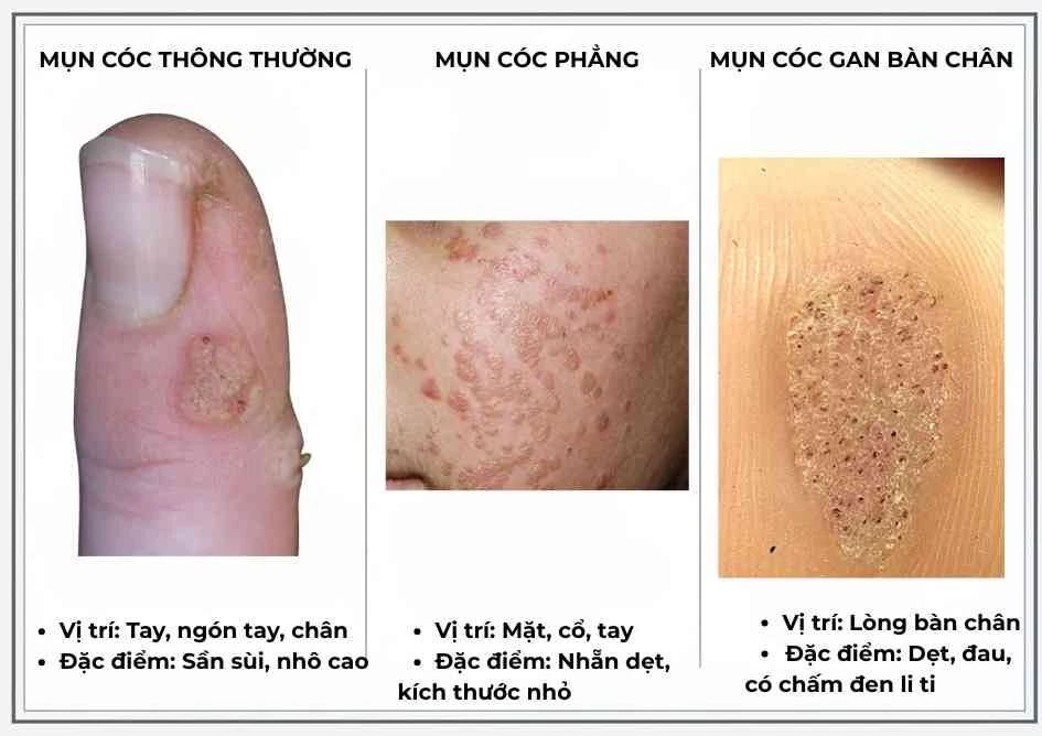 mụn cóc nhiều vị trí - Image 4