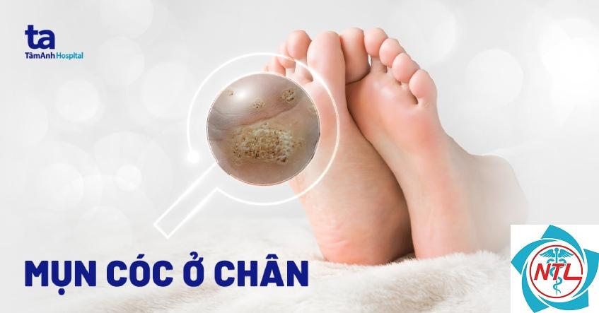 mụn cóc ở bàn chân - Image 2