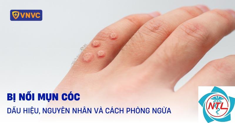 mụn cóc ở bàn tay - Image 5