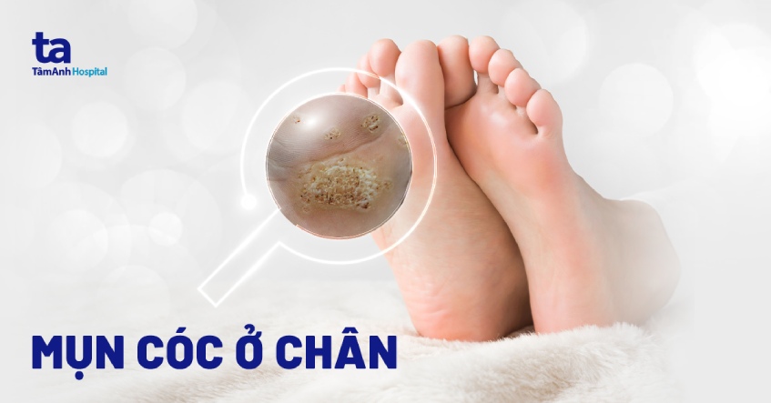mụn cóc ở chân - Image 2