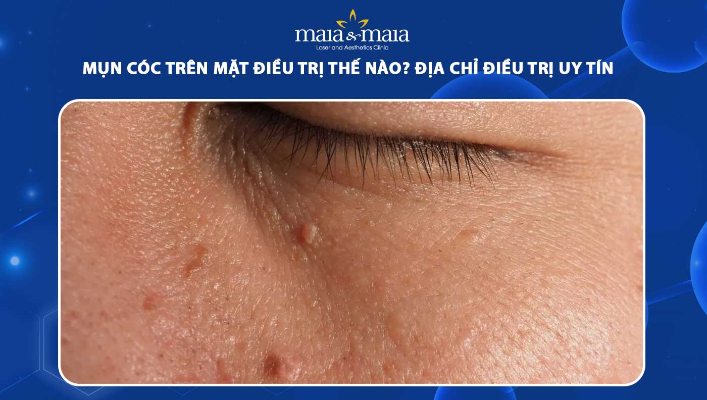 mụn cóc ở mặt - Image 3