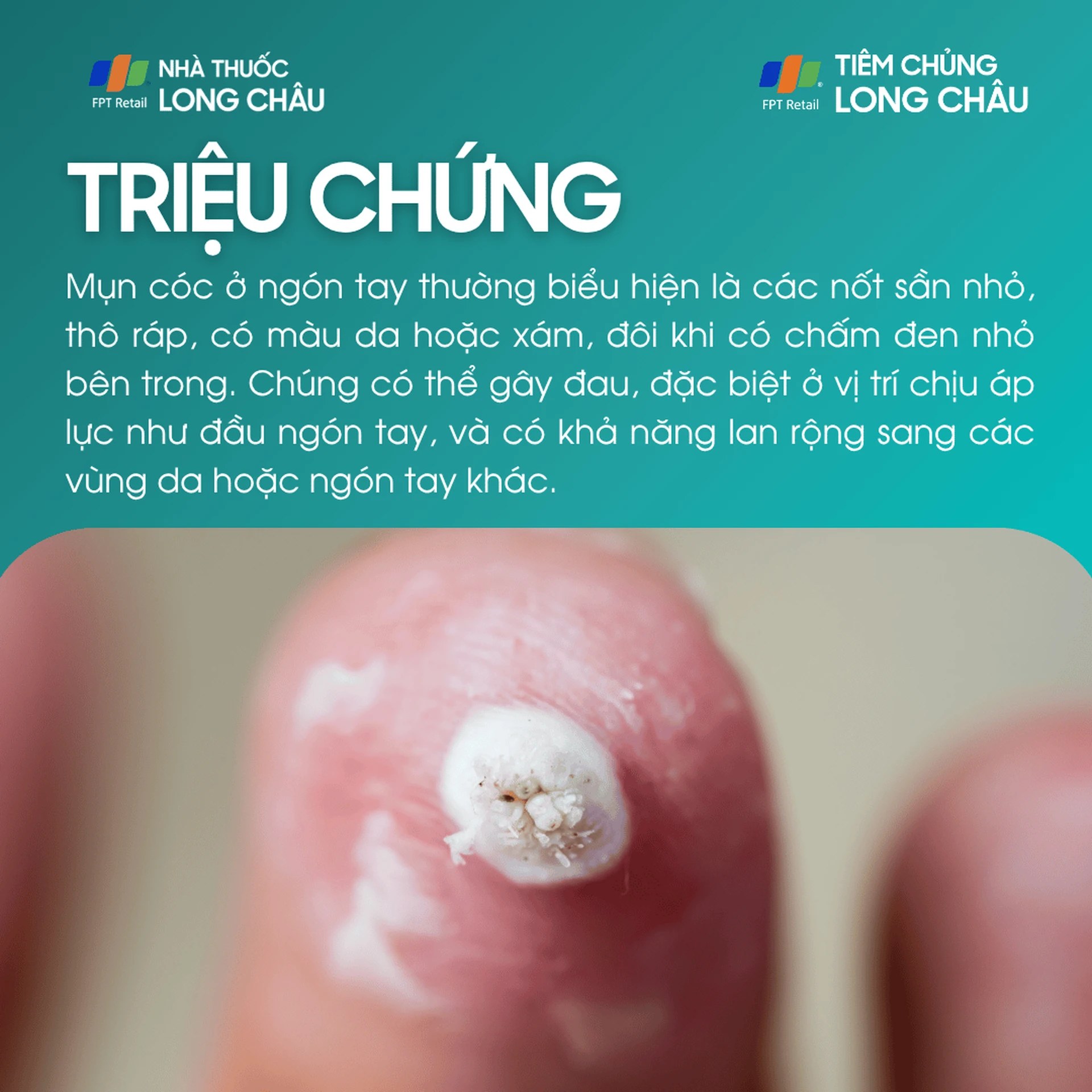 mụn cóc ở ngón tay - Image 4