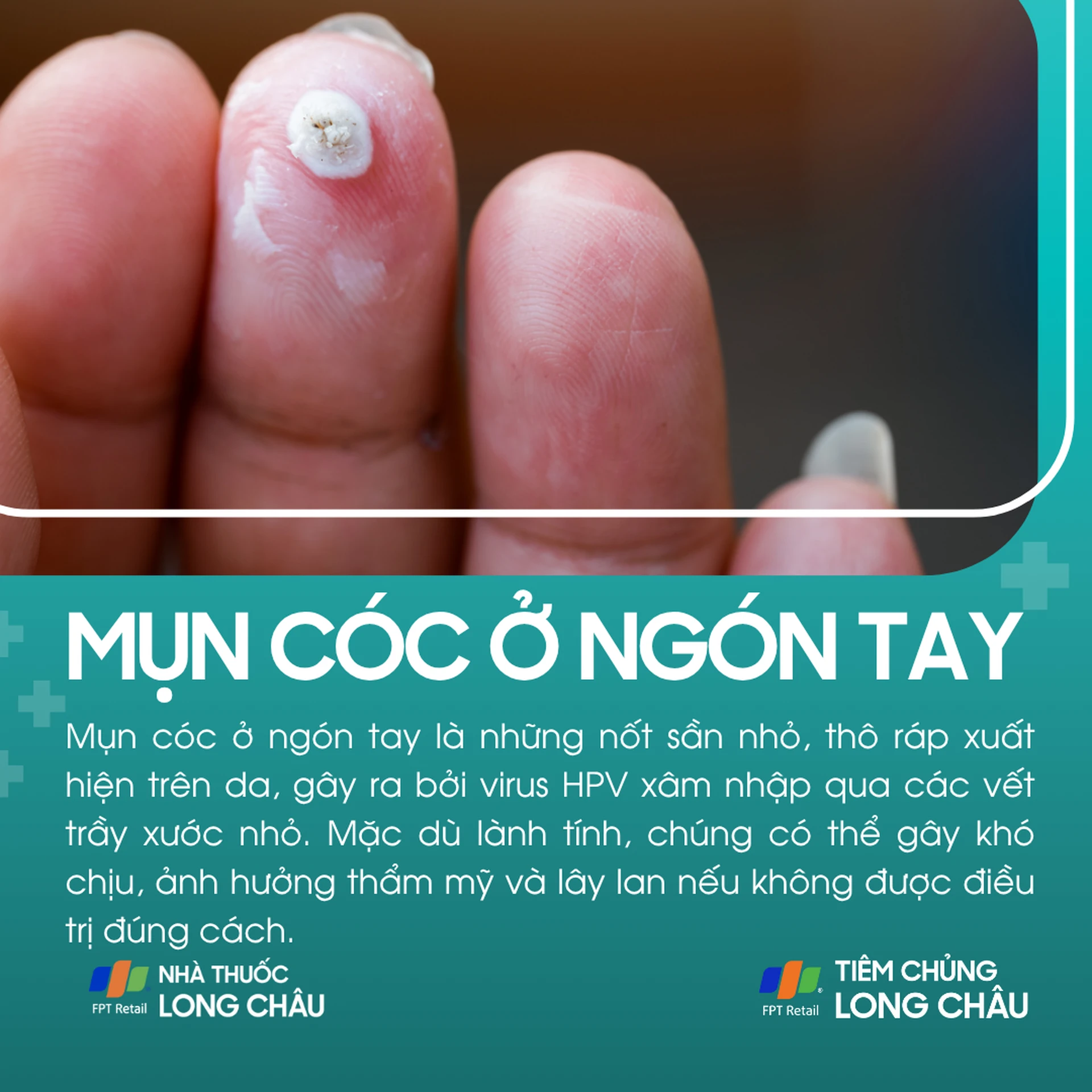 mụn cóc ở tay - Image 3