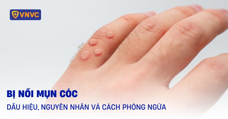 mụn cóc ở tay - Image 5