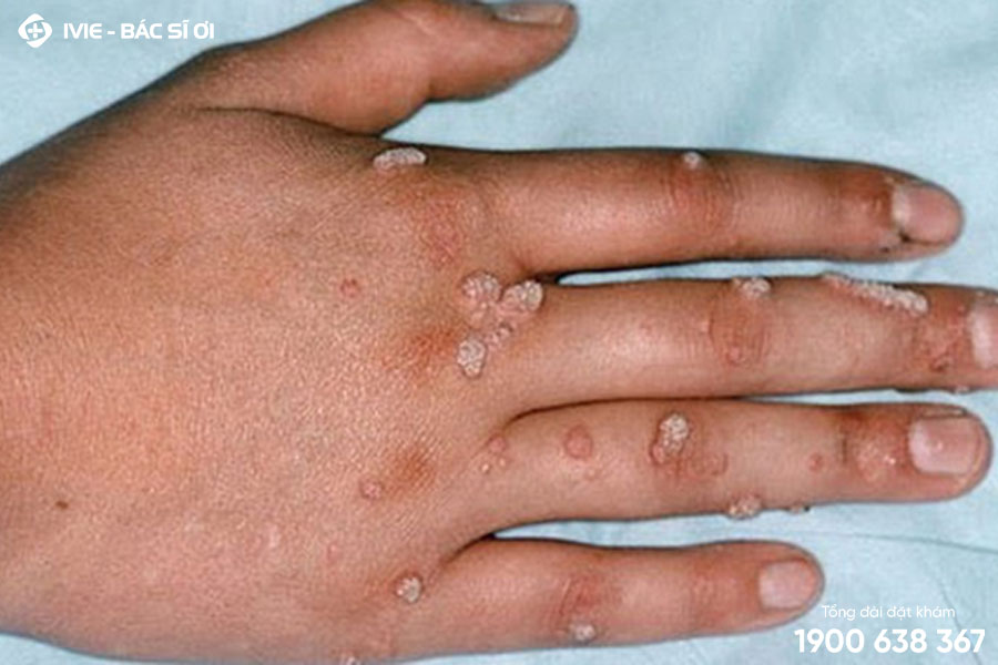 mụn cóc ở tay