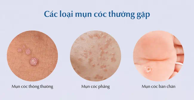 mụn cóc ở trẻ em - Image 2