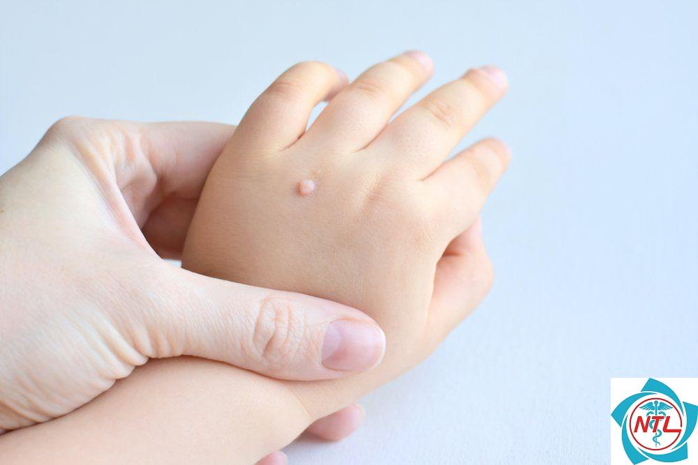 mụn cóc ở trẻ em