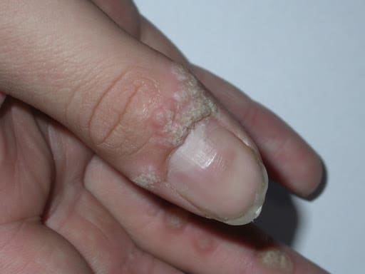 mụn cóc quanh móng - Image 5