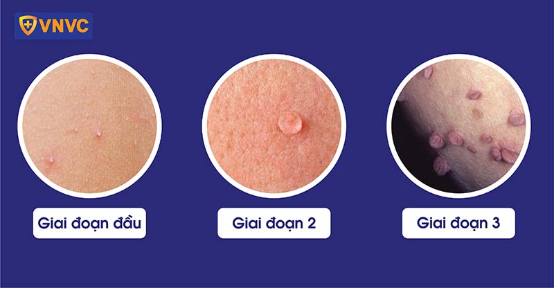 mụn cóc sinh dục - Image 2