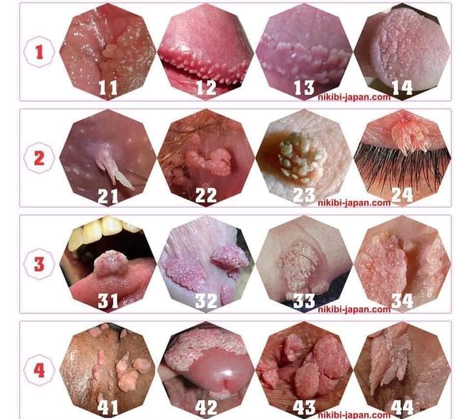 mụn cóc sinh dục - Image 4