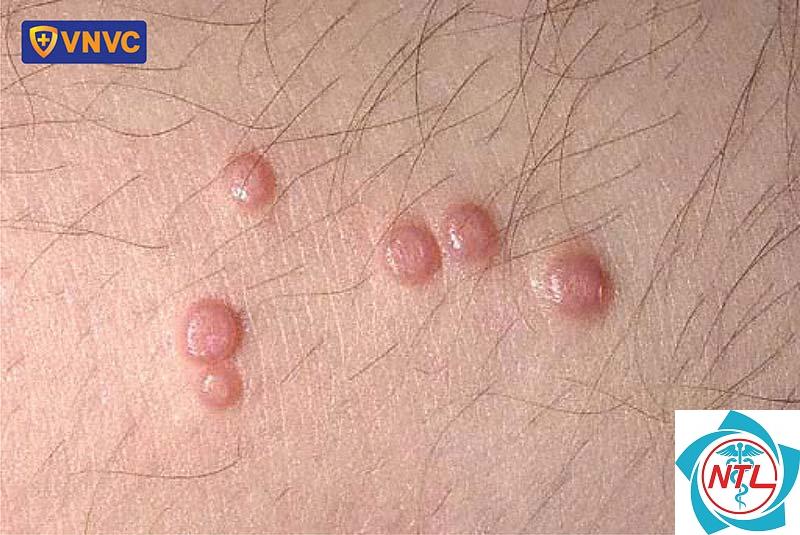 mụn cóc sinh dục do HPV - Image 2