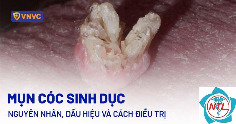 mụn cóc sinh dục do HPV - Image 3
