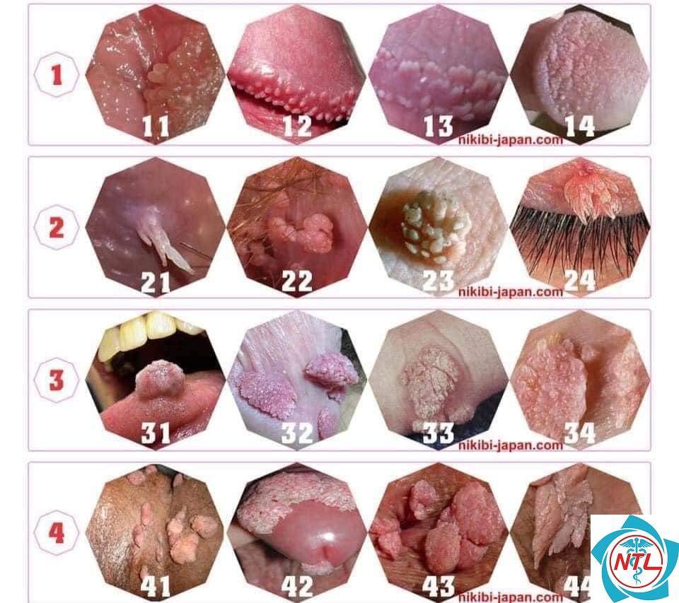 mụn cóc sinh dục do HPV - Image 4