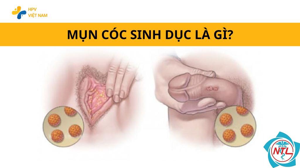 mụn cóc sinh dục do HPV