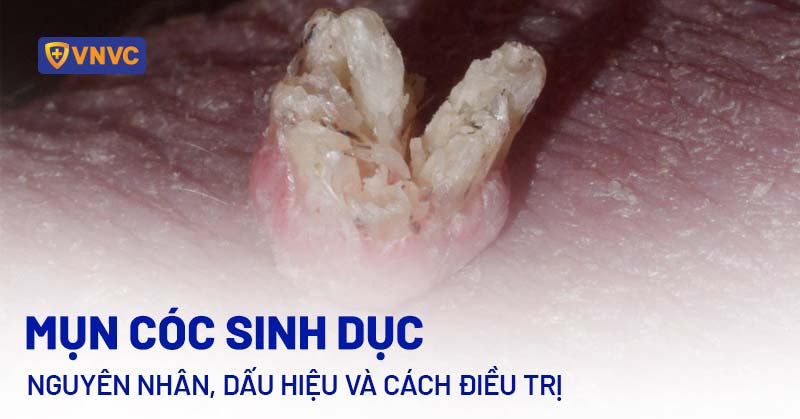 mụn cóc sinh dục