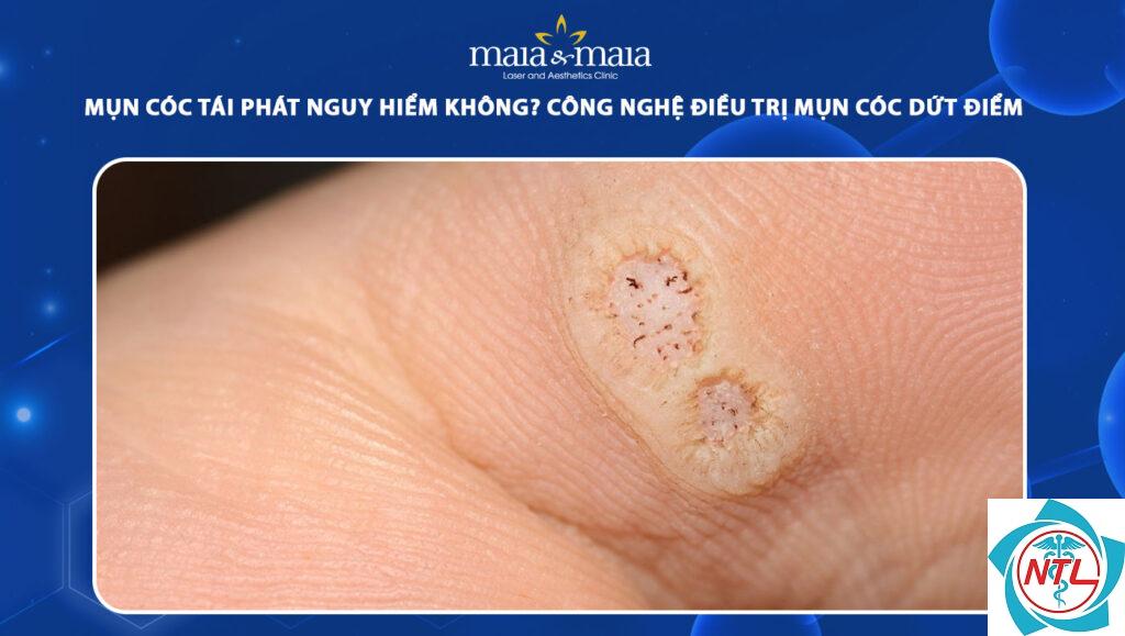 mụn cóc tái phát