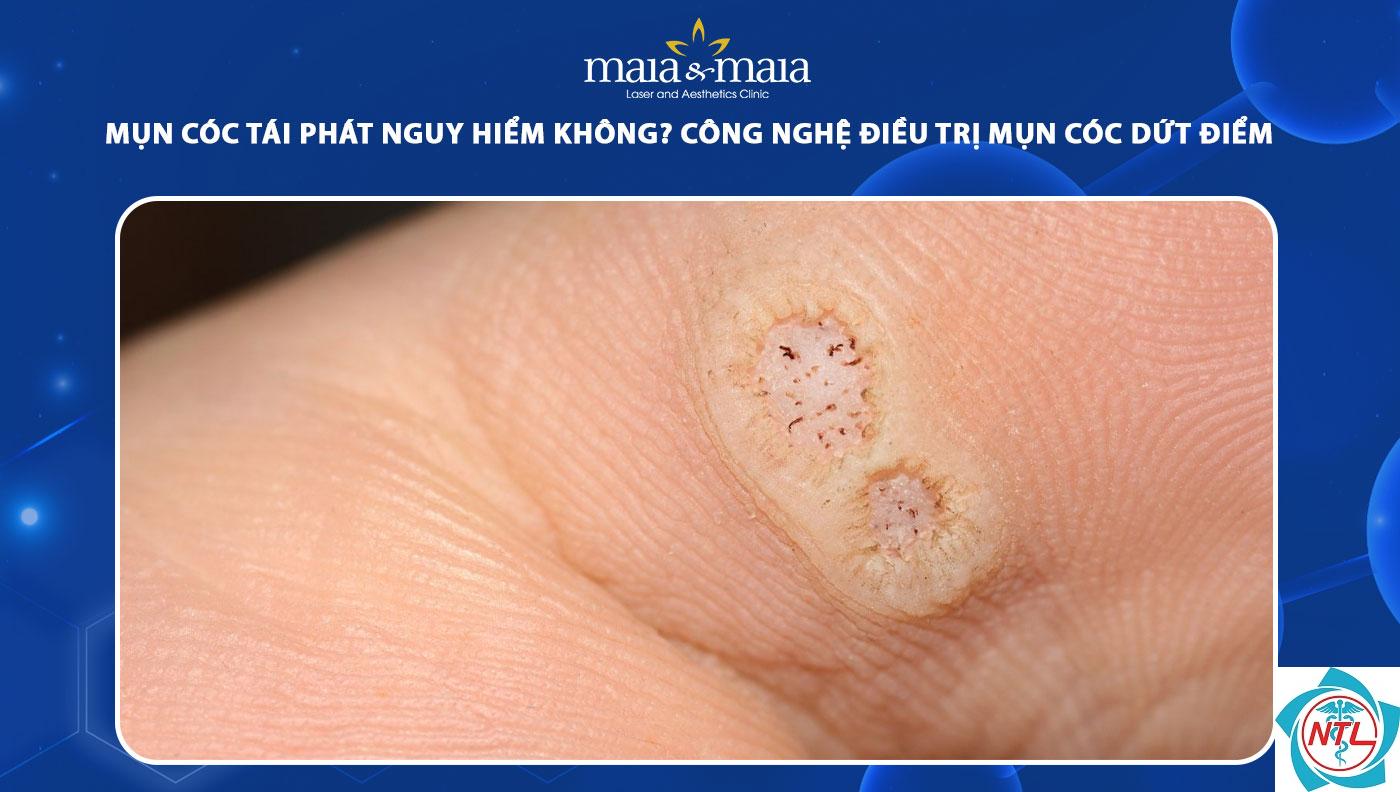 mụn cóc tái phát - Image 1