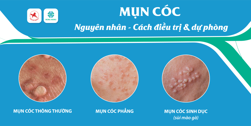 mụn cóc