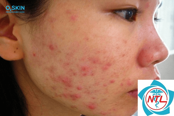 mụn do corticosteroid - Image 3