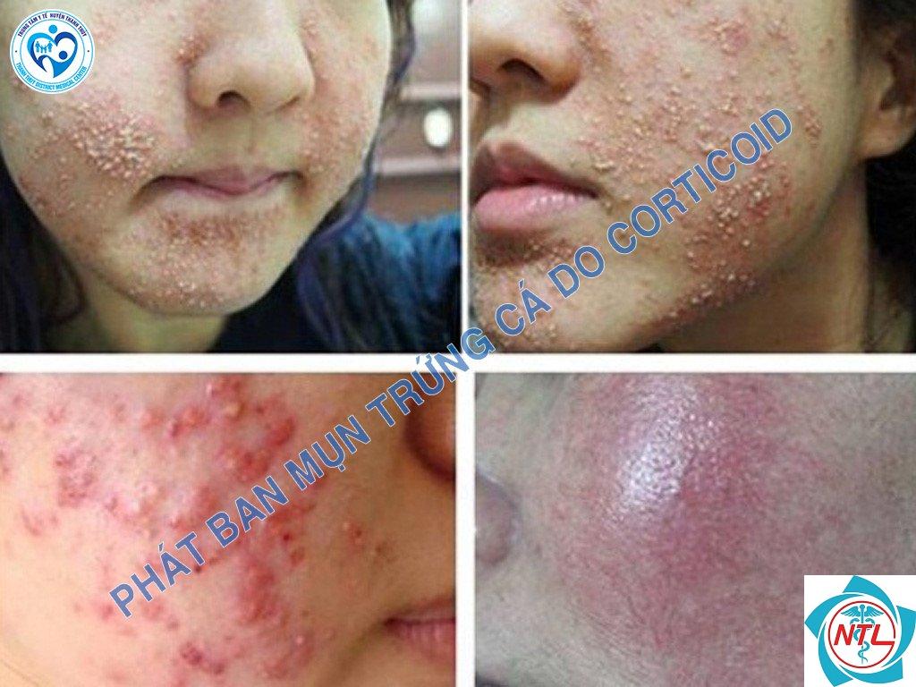 mụn do corticosteroid - Image 5