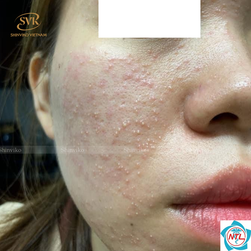 mụn do corticosteroid