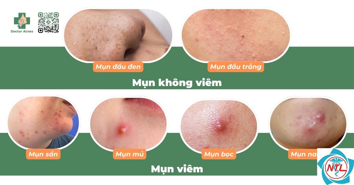 mụn do thuốc - Image 2