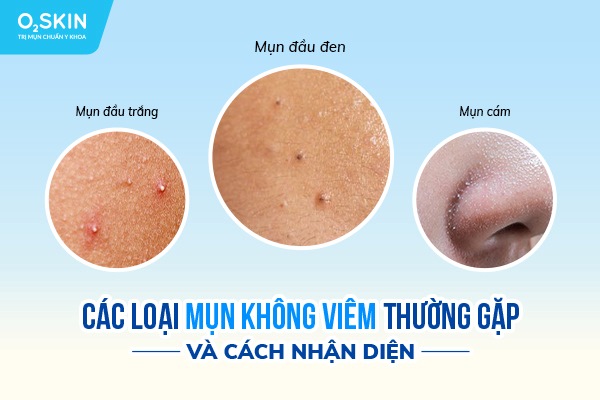 mụn không viêm - Image 2