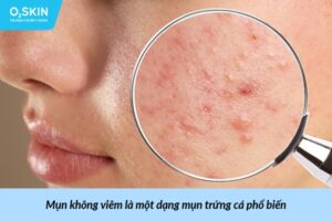 mụn không viêm