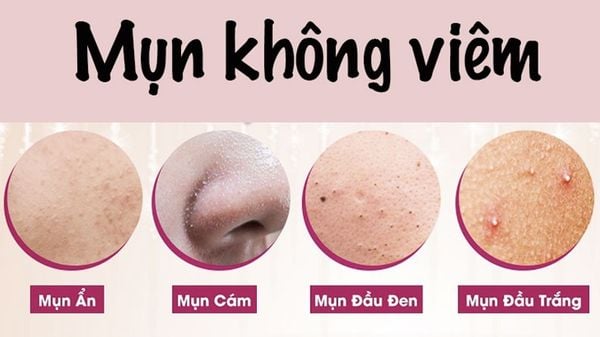mụn không viêm - Image 4