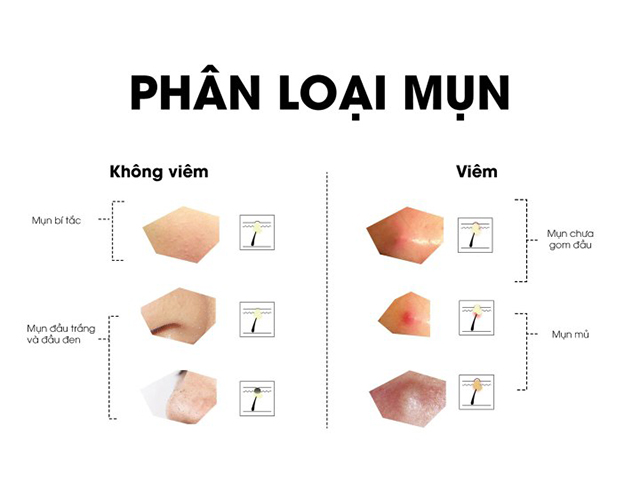 mụn không viêm - Image 5