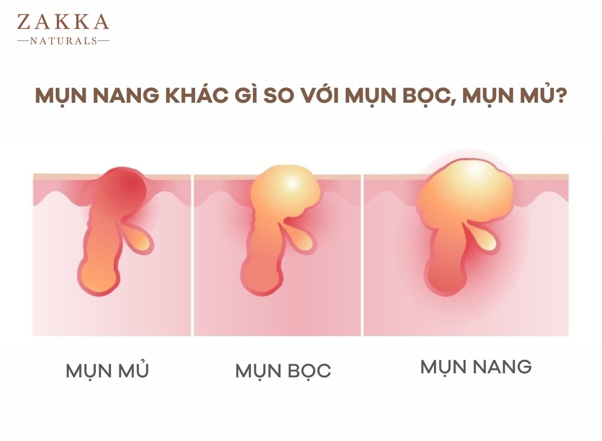 mụn nang - Image 2
