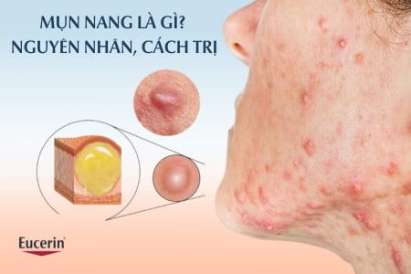 mụn nang - Image 4