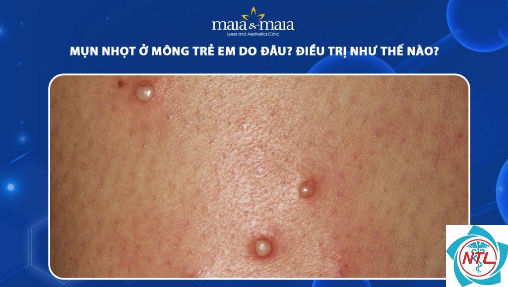 mụn ở mông - Image 5