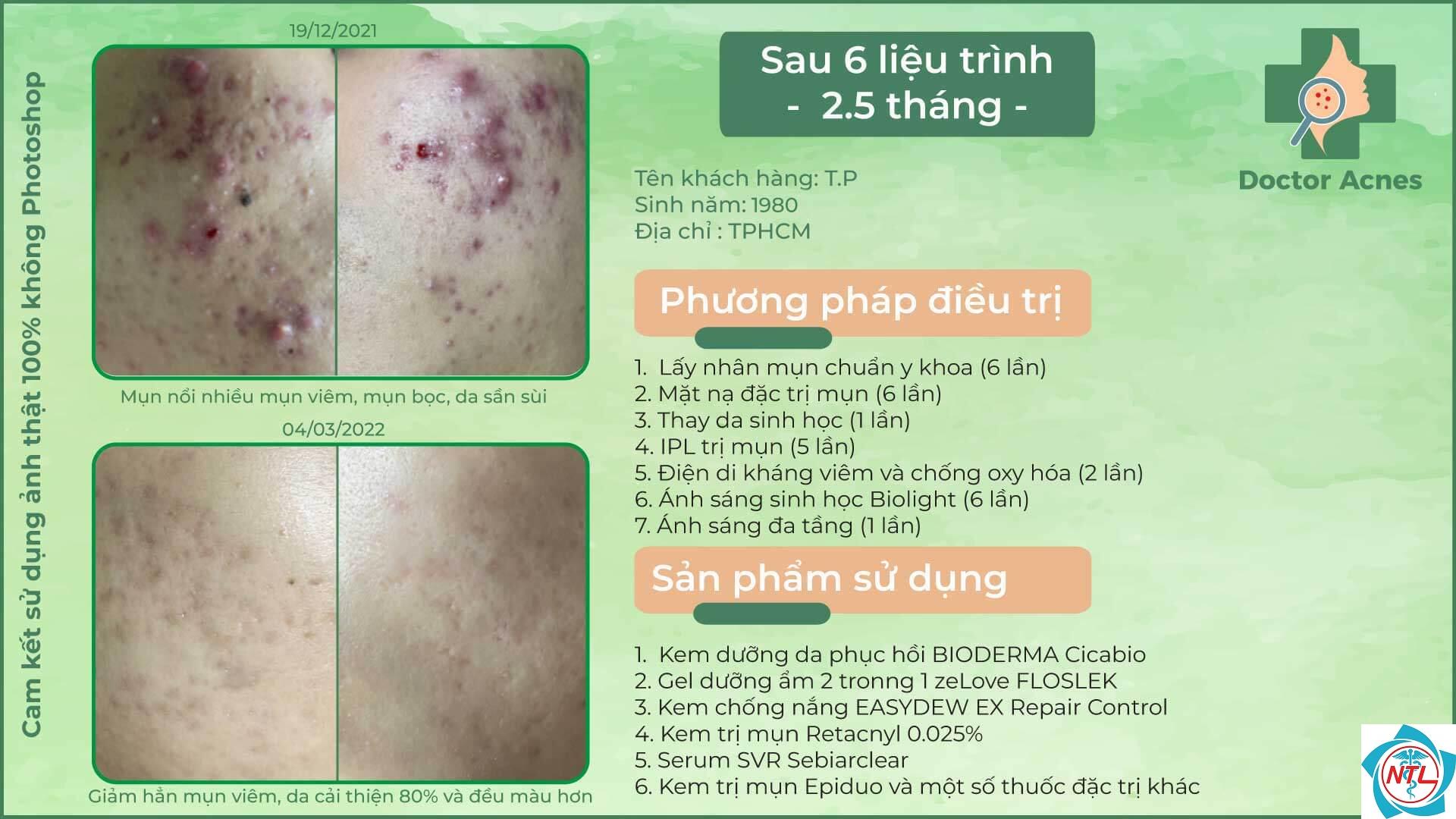 mụn ở người trưởng thành - Image 2