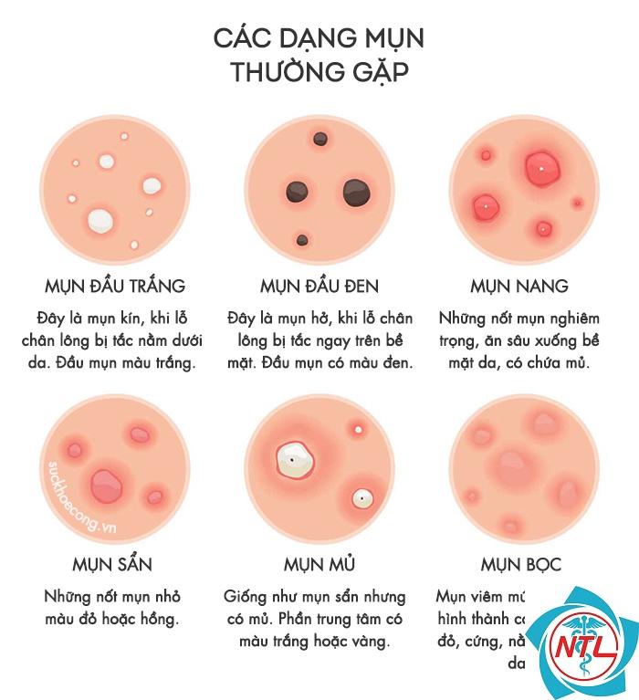 mụn ở người trưởng thành - Image 5