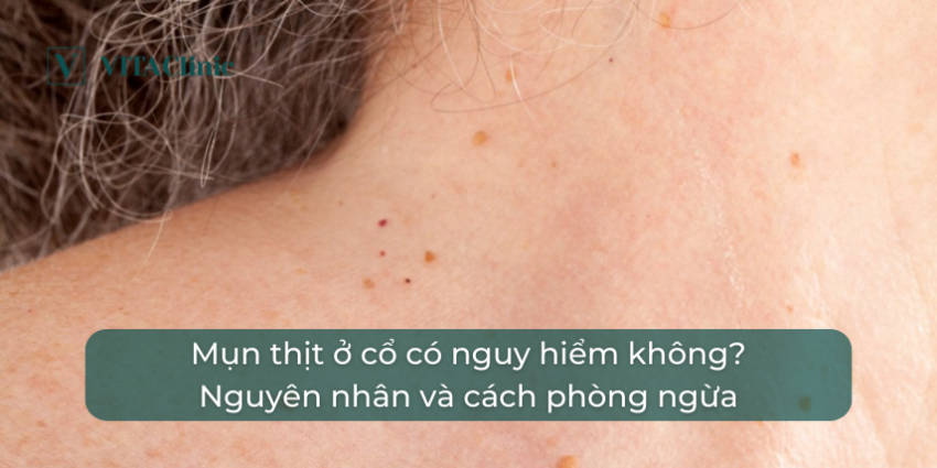 mụn thịt ở cổ - Image 5