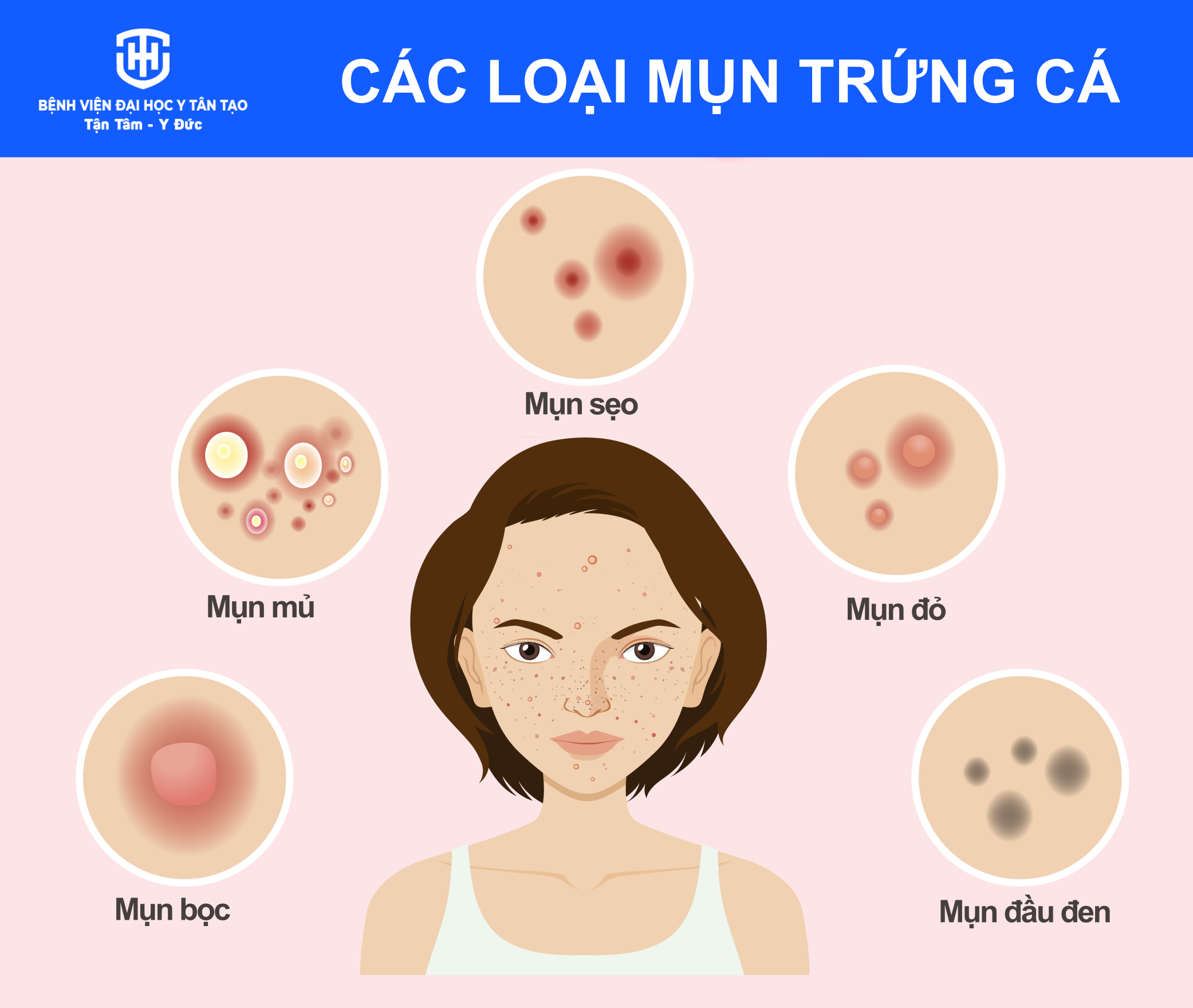 mụn trứng cá - Image 2