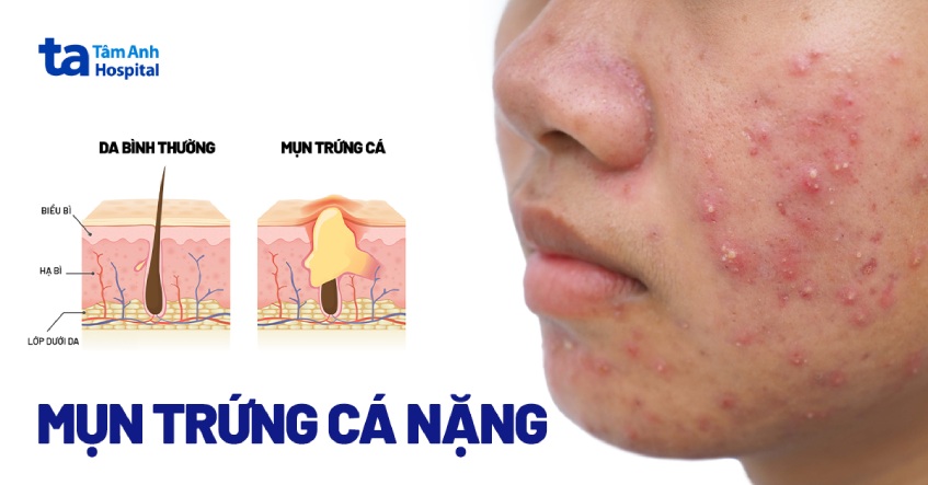 mụn trứng cá - Image 4