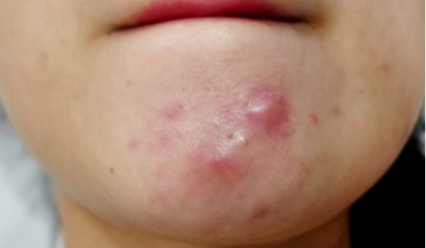 mụn trứng cá bọc - Image 2