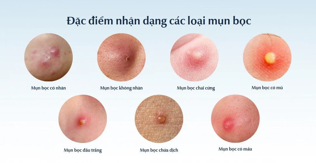 mụn trứng cá bọc - Image 3