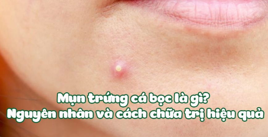 mụn trứng cá bọc - Image 4