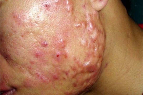 mụn trứng cá để lại sẹo - Image 2