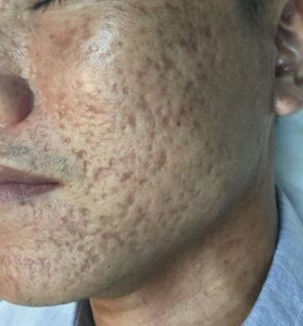 mụn trứng cá để lại sẹo